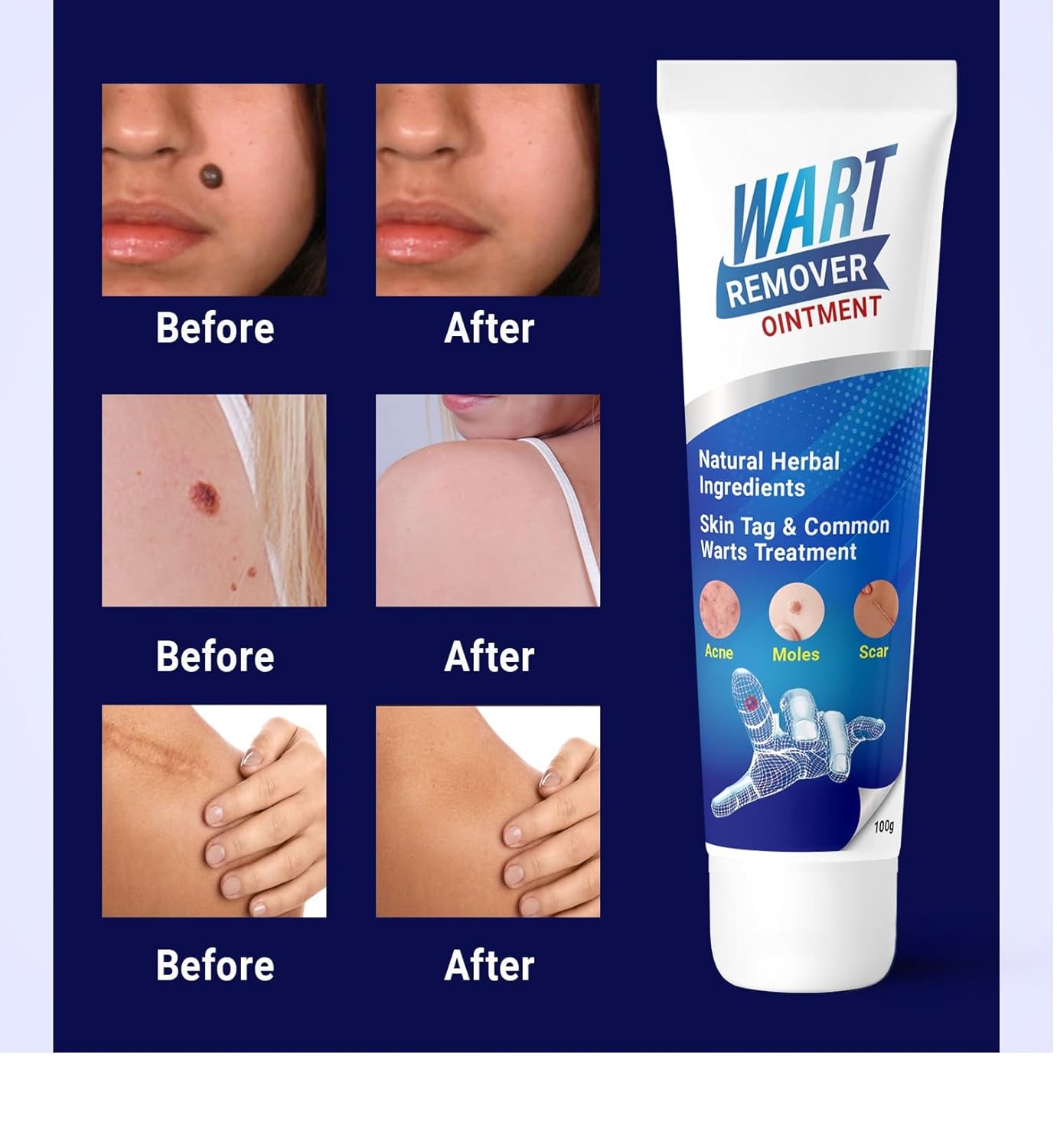 Medigo Wart remover ointment, Wart remover cream for Wart removal (100gm) | massa remover ointment for skin tag
