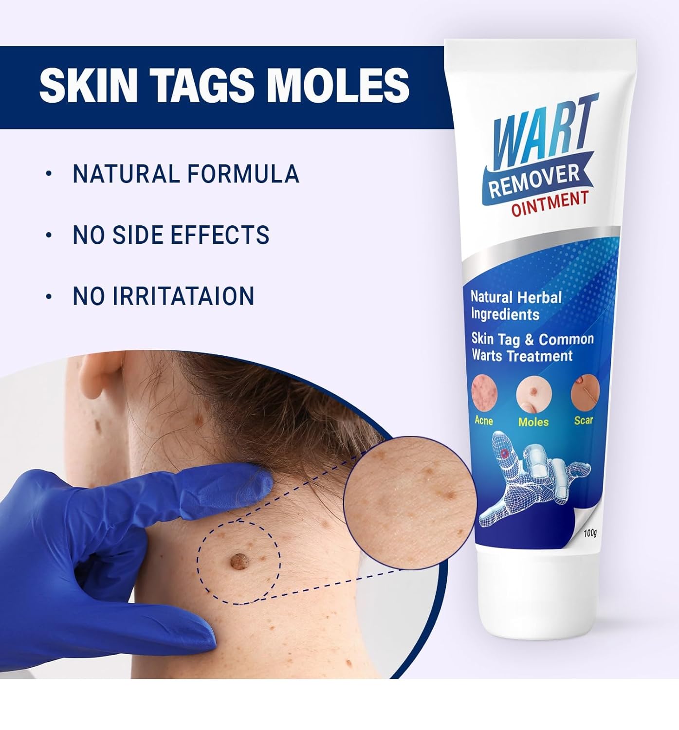 Medigo Wart remover ointment, Wart remover cream for Wart removal (100gm) | massa remover ointment for skin tag